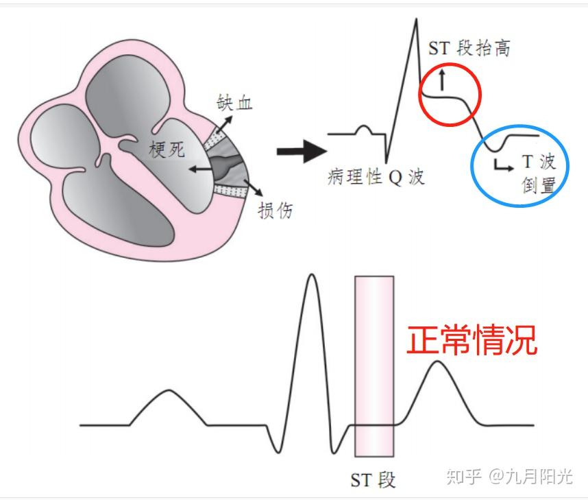 体育生心脏T波异常，探究原因、分析及建议