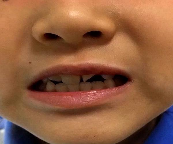 学生体育课摔掉牙，意外事件下的反思与启示