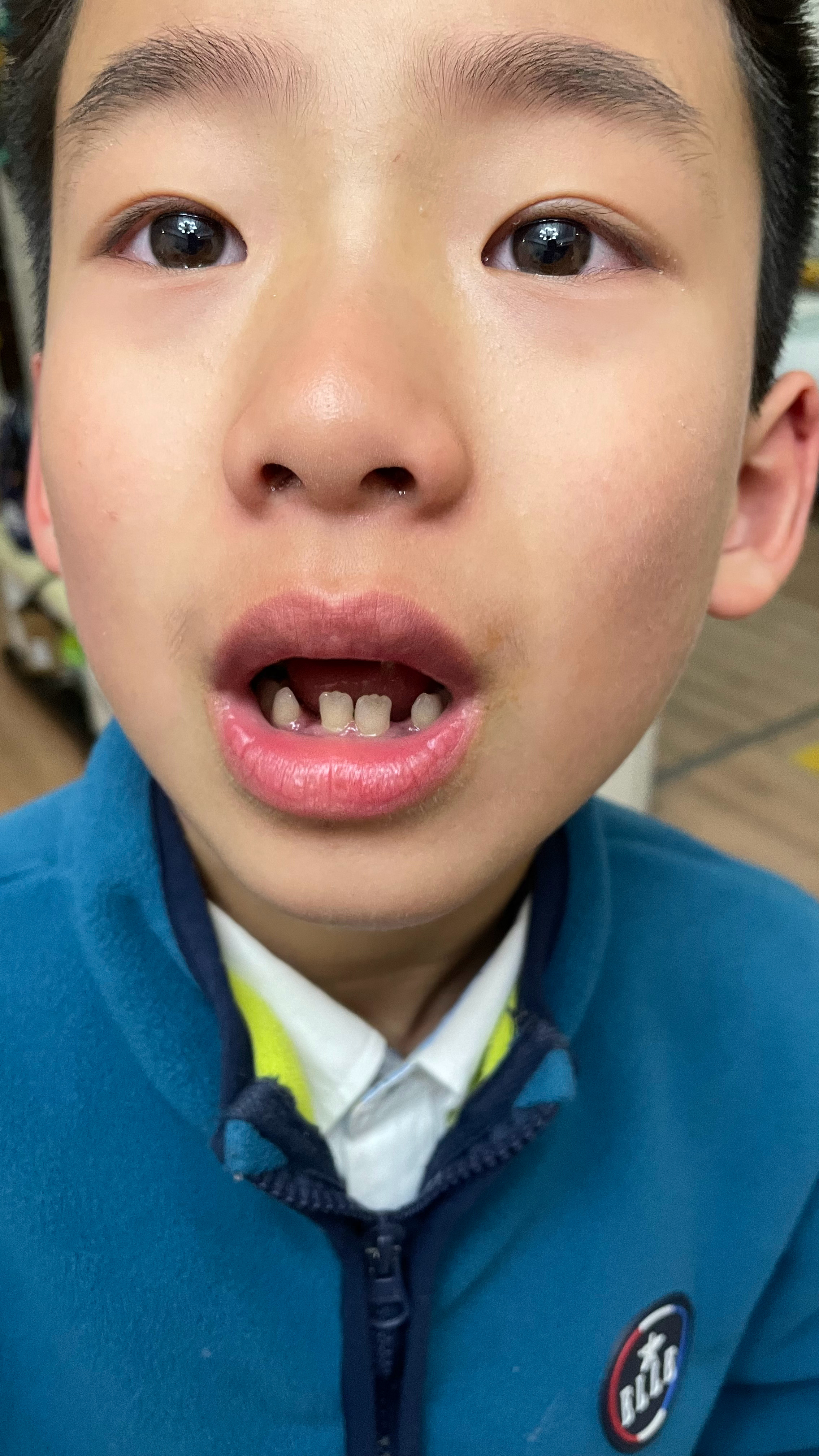 学生体育课摔掉牙，意外事件下的反思与启示