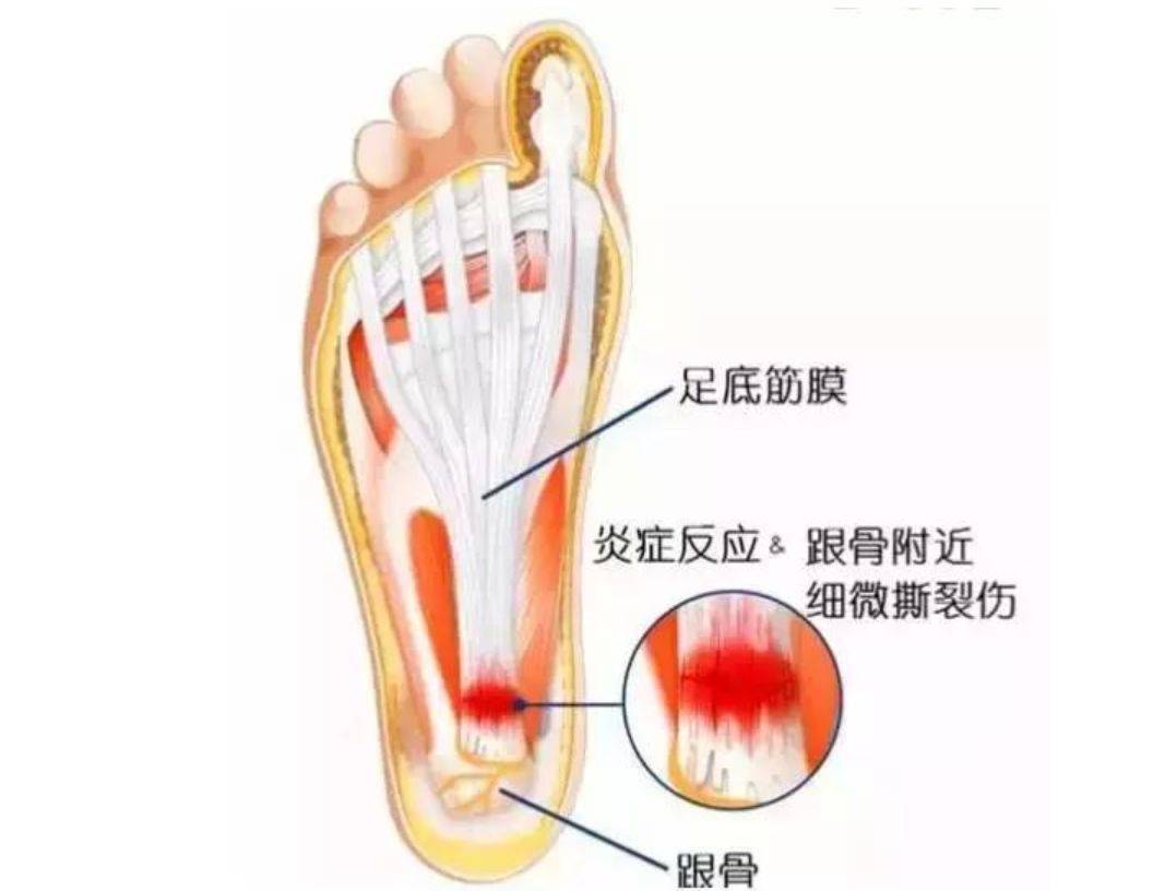 体育生的足底筋膜炎挑战与应对策略