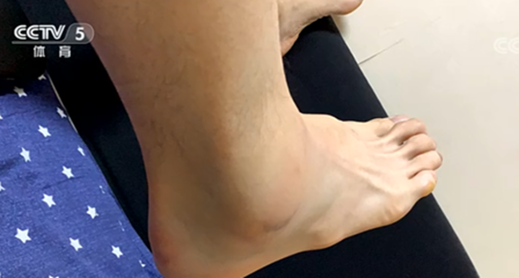 体育生脚踝痛咋办？全面解析与应对建议